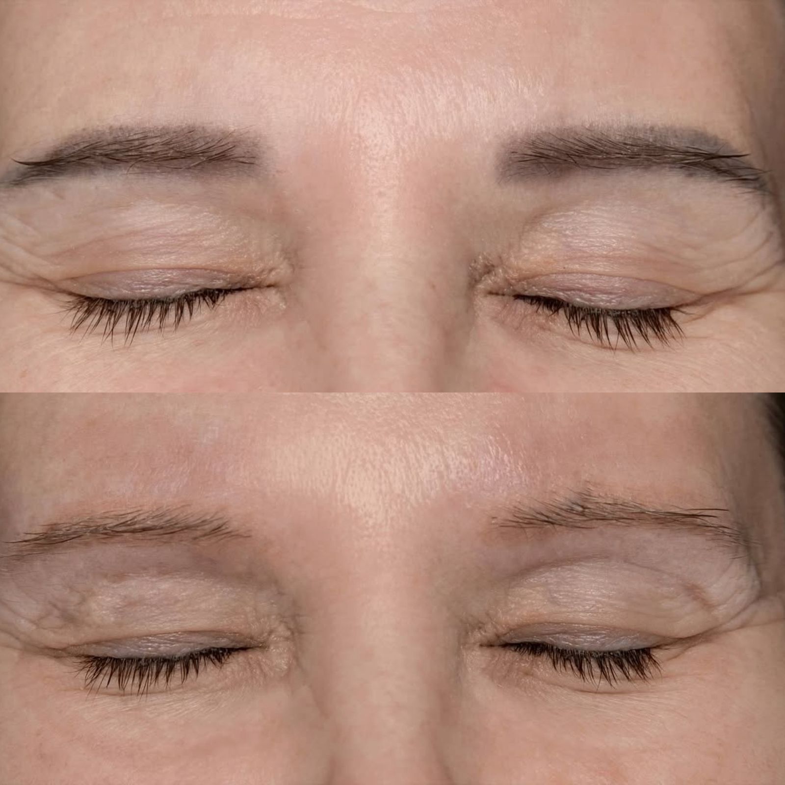 Resultado de remoção a laser